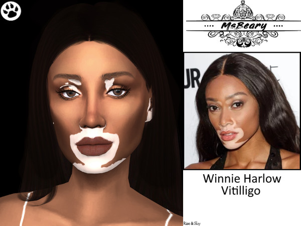 Sims 4 — Winnie Harlow Vitiligo Skin Pattern by MsBeary — This was inspired by the beautiful model, Winnie Harlow! Enjoy